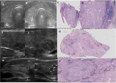 Ultrasound evolution of parenchymal changes in the thyroid gland with autoimmune thyroiditis in children prior to the development of papillary thyroid carcinoma – a follow-up study